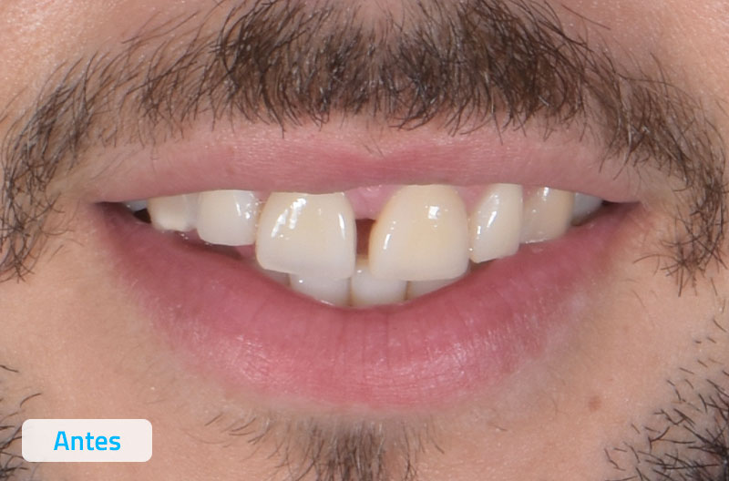 Caso clínico ortodoncia invisible