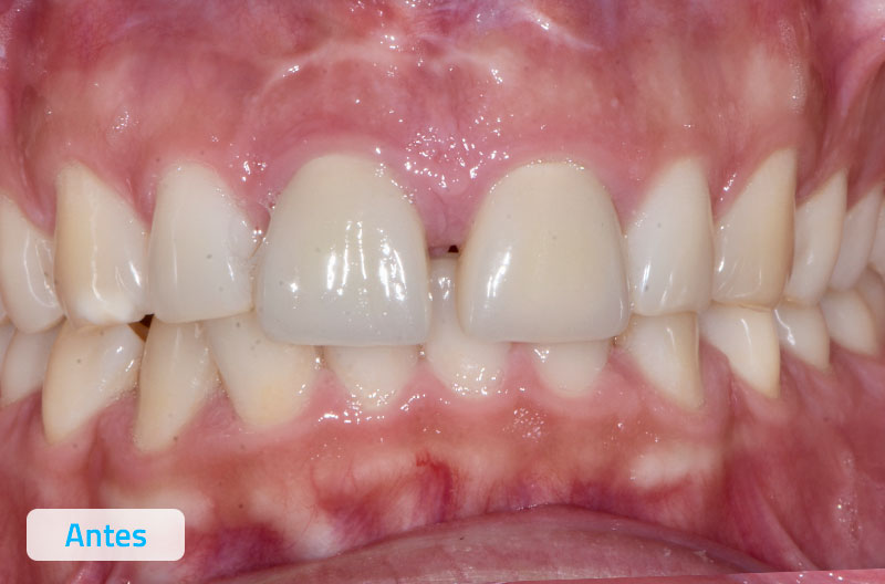Caso clínico ortodoncia invisible
