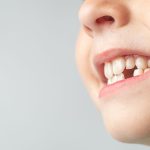 niño con manchas blancas en los dientes