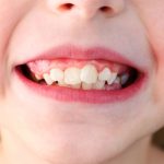 niña que sufre de apiñamiento dental