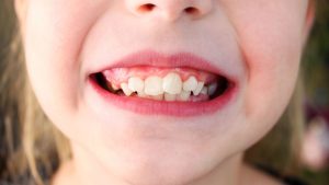 niña que sufre de apiñamiento dental