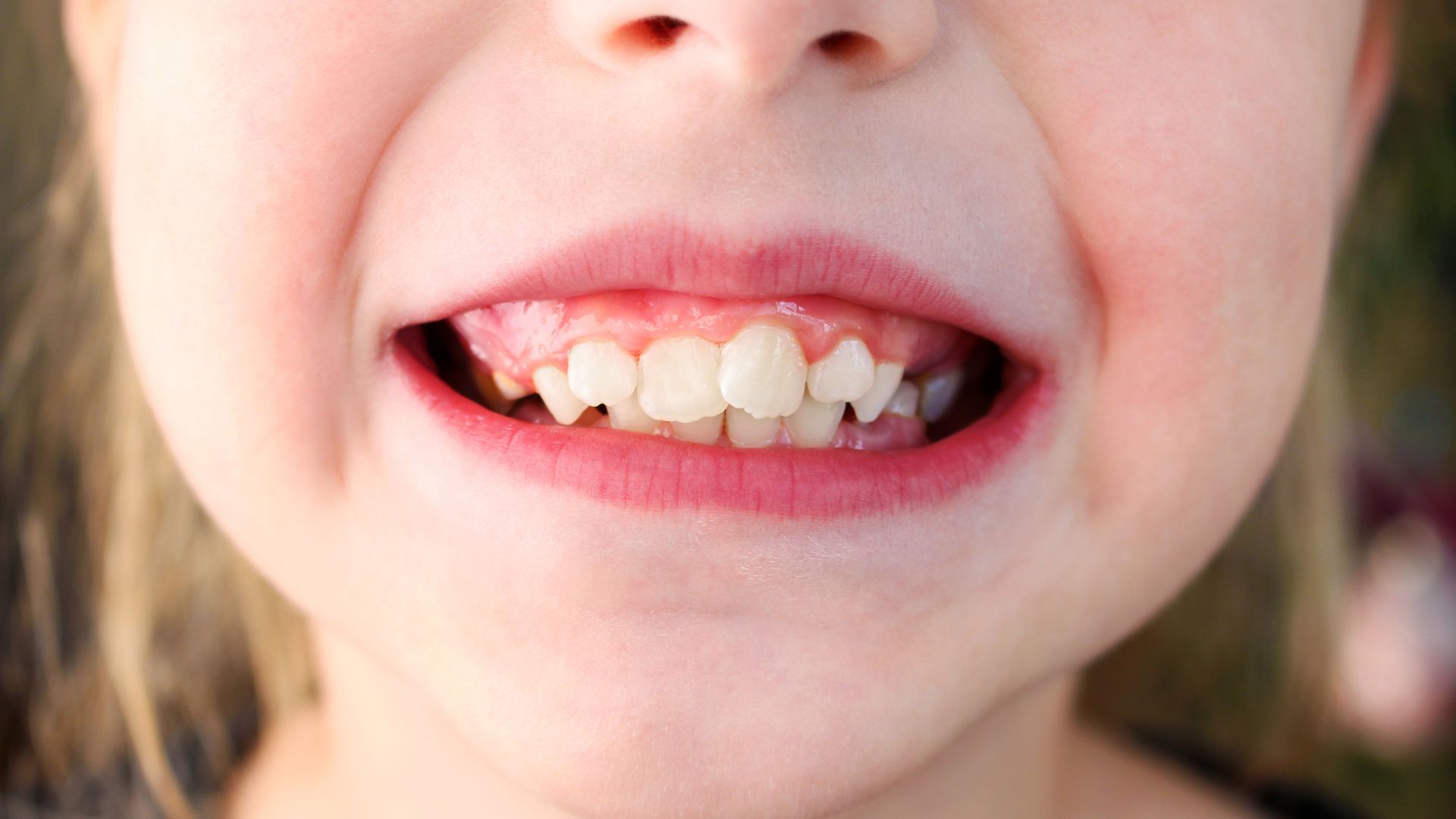 niña que sufre de apiñamiento dental