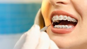 mujer con brackets en una revisión del tratamiento de ortodoncia