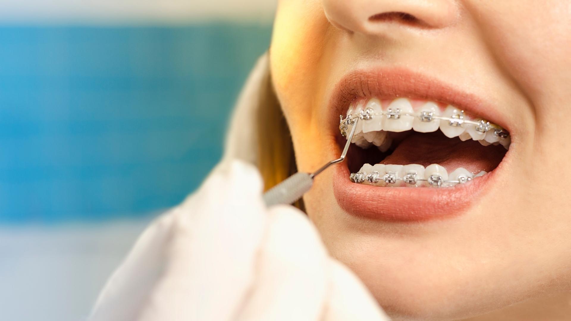 mujer con brackets en una revisión del tratamiento de ortodoncia