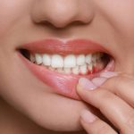 Mujer enseñando los dientes con las encías enrojecidas