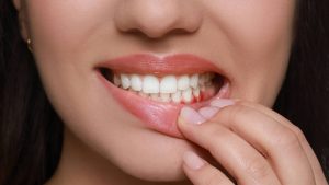 Mujer enseñando los dientes con las encías enrojecidas