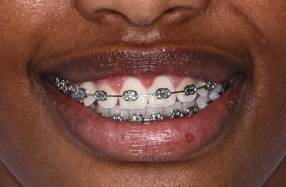 Antes brackets metálicos