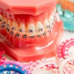 molde de brackets con gomas de colores para brackets