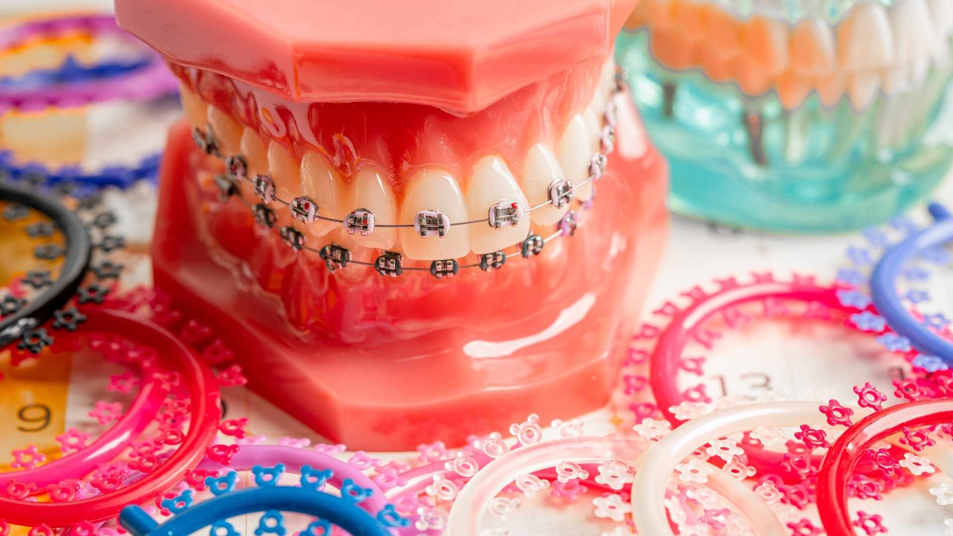 molde de brackets con gomas de colores para brackets